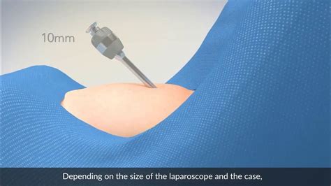 water drop test laparoscopy|Principles of safe abdominal entry in laparoscopic gynecologic .